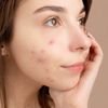 Close-up portrait of a young woman with acne, hand on face, pensive expression.