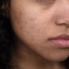 Close-up shot focusing on natural skin and acne scars, showcasing authenticity and real beauty.